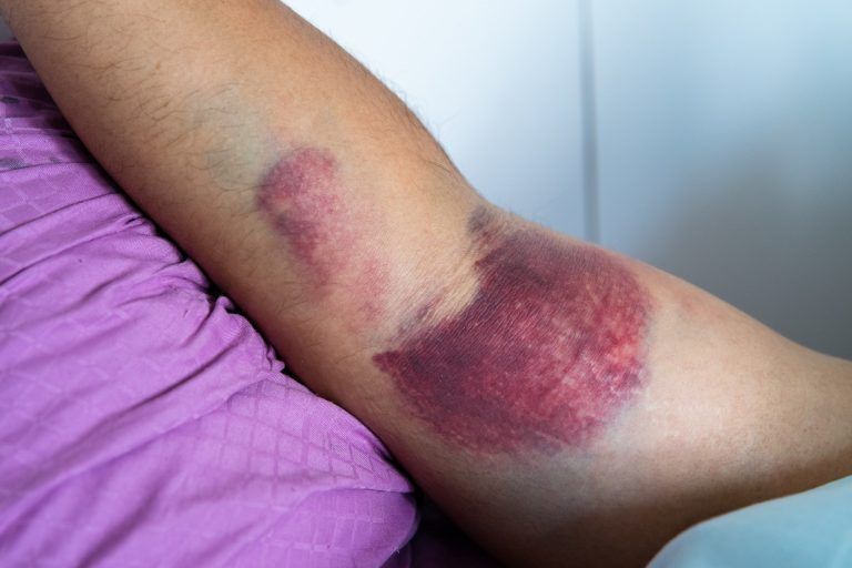 Desgarro o tensión de bíceps, lesiones de tendón en una mano de hombre musculoso. Traumatismo o traumatismo.