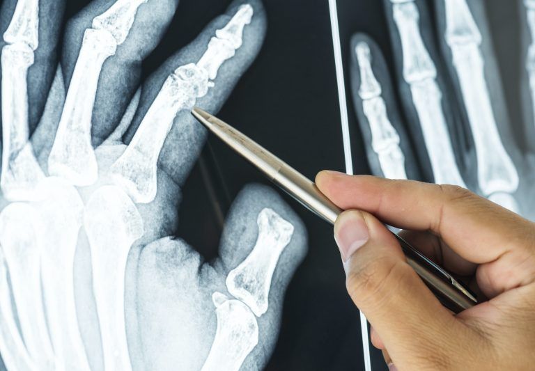 Primer plano de una película de rayos X de un dedo fracturado